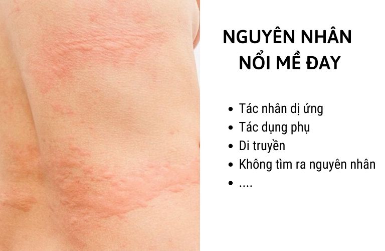 Nhiều nguyên nhân gây bệnh mày đay