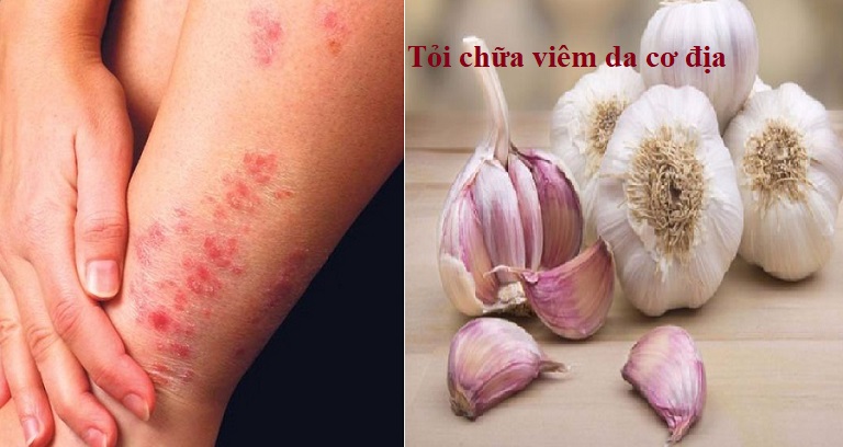 Tỏi chữa viêm da cơ địa