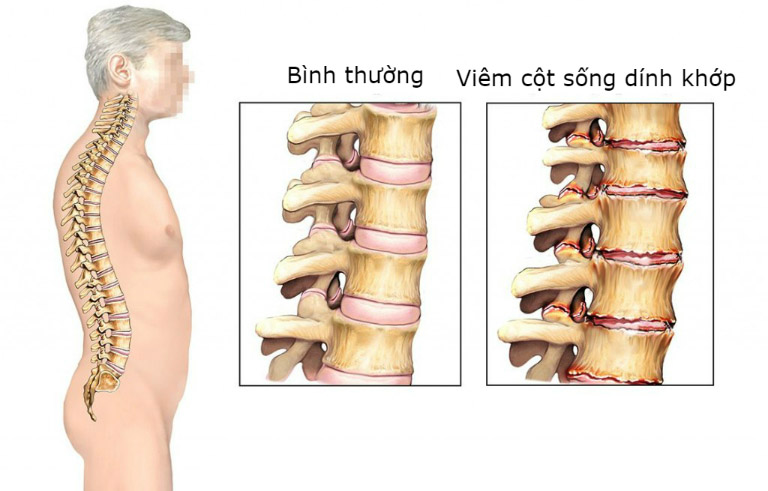 Viêm cột sống dính khớp cũng là một nguyên nhân khiến người bệnh khó vận động