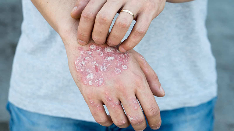 Hình ảnh bệnh chàm eczema ở tay