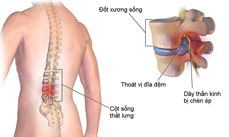 Bệnh thoát vị đĩa đệm - bệnh lý xương khớp ngày càng phổ biến