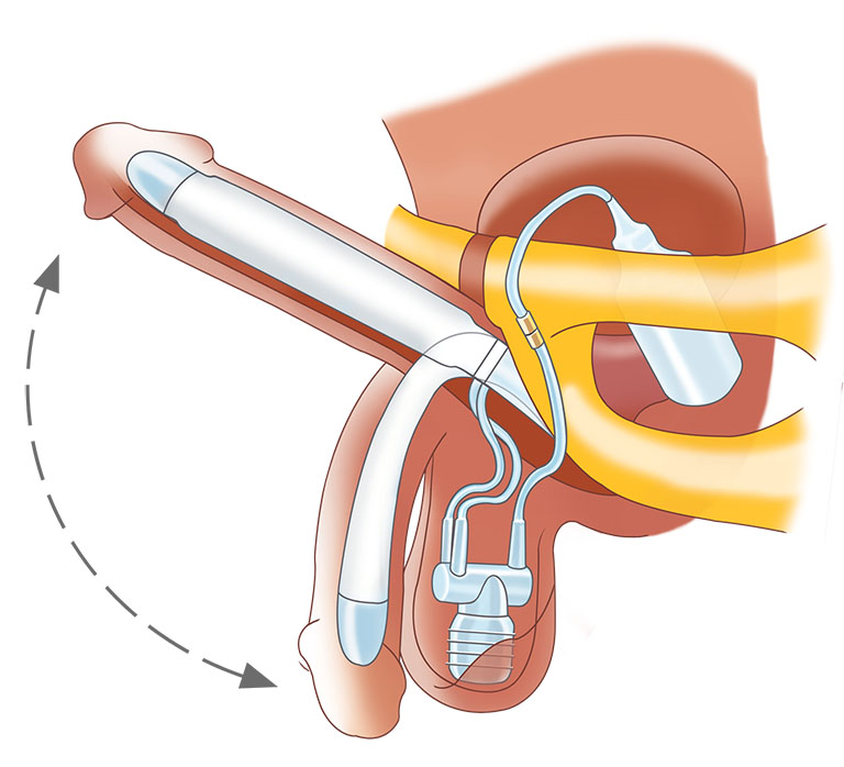 Cấy ghép dương vật giúp tăng độ cương cứng