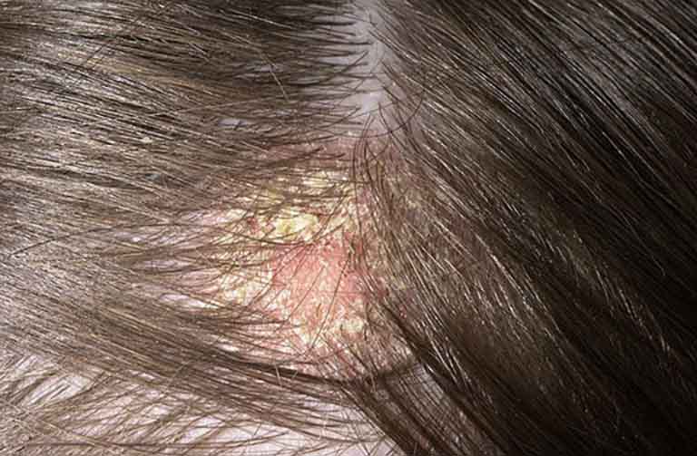 Giữ vệ sinh cơ thể, gội đầu thường xuyên để điều trị nấm da đầu hiệu quả