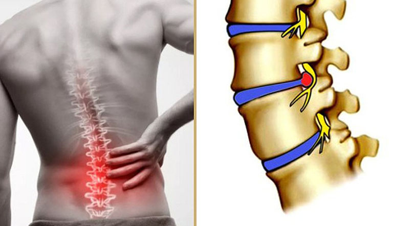 Thoát vị đĩa đệm gây ra những cơn đau nghiêm trọng tại thắt lưng, người bệnh khó vận động