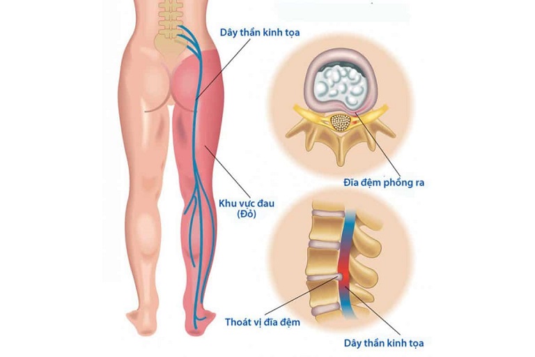 Rất nhiều người băn khoăn không biết thoát vị đĩa đệm có nguy hiểm không