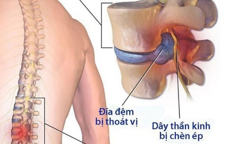 Thoát vị đĩa đệm là bệnh xương khớp thường gặp ở nhiều người