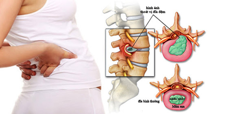 Chữa thoát vị đĩa đệm bằng bấm huyệt được nhiều người bệnh sử dụng