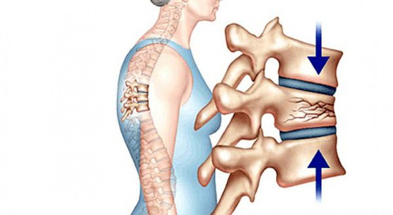 Thoái hóa cột sống ở người trẻ khá nguy hiểm, gây nhiều biến chứng khó lường