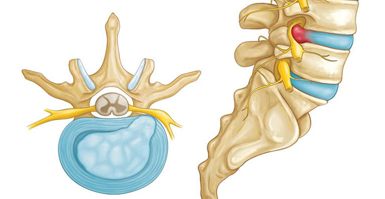 Thoát vị đĩa đệm L4,L5 là một dạng bệnh lý xương khớp phổ biến