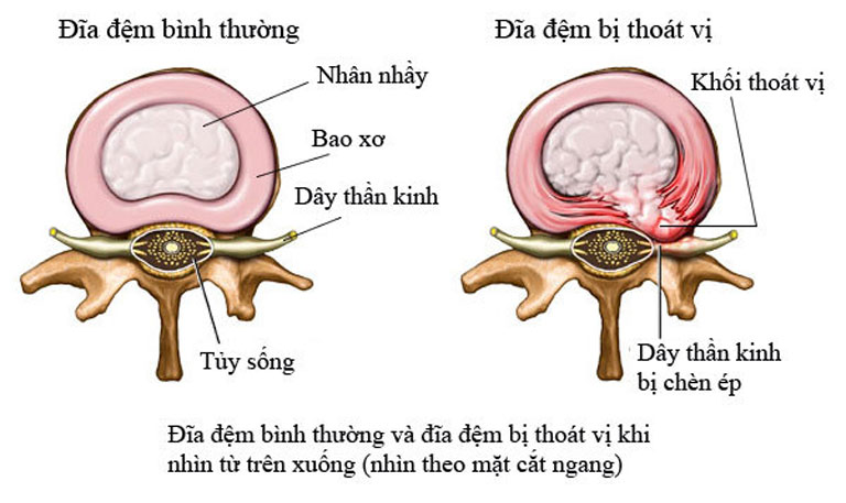 Rách bao xơ đĩa đệm là giai đoạn bệnh bắt đầu trở nặng của thoát vị đĩa đệm