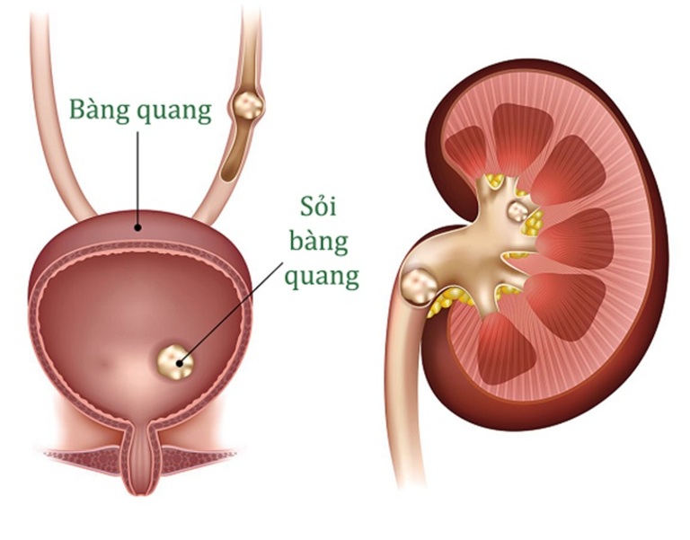 Sỏi kích thích lên niêm mạc bàng quang khiến cơ quan này bị đau nhức