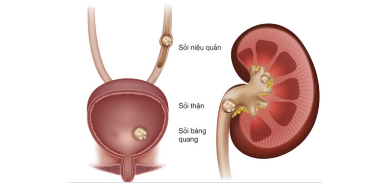 Sỏi niệu quản là dạng sỏi đường tiết niệu có mức độ nghiêm trọng và dễ gây ra các biến chứng nặng nề