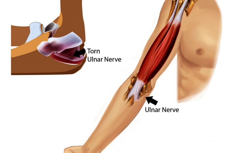 Nơi kết nối giữa xương khuỷu tay và xương cánh tay trên