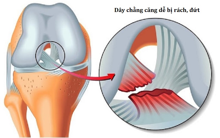 Dây chằng căng dễ bị rách hoặc đứt