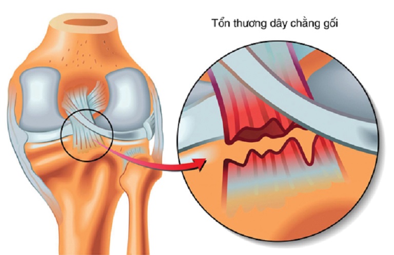 Hình ảnh đứt dây chằng đầu gối