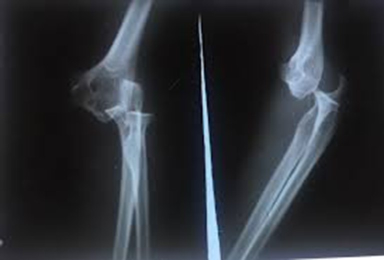 Ảnh X-quang người bị trật khớp ở cánh tay