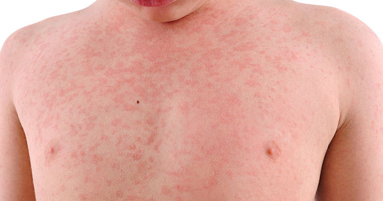 Bị nổi đỏ ngứa khắp người do nhiễm virus siêu vi