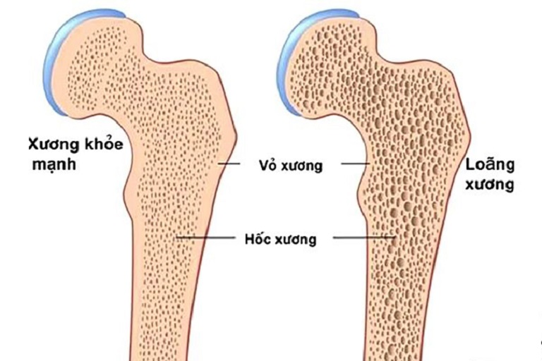 Loãng xương khiến xương yếu và dễ bị gãy