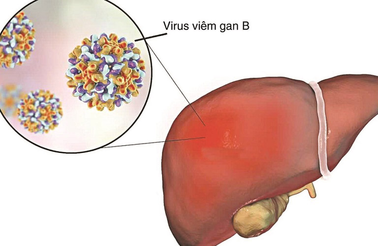 Dứa dại là một vị thuốc hỗ trợ điều trị bệnh viêm gan B