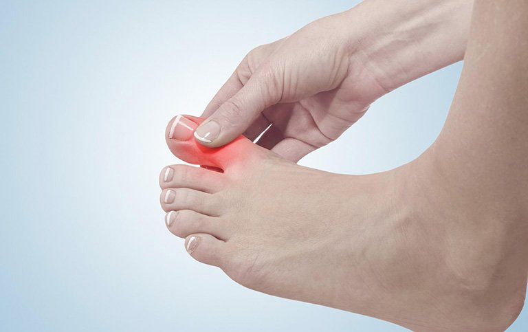 Bệnh gout hình thành do rối loạn chuyển hóa nhân purin ở thận