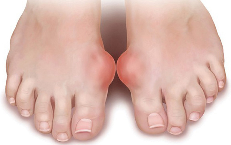 Gout cấp gây sưng viêm, đau nhức cho người bệnh