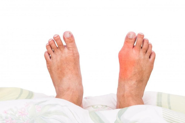 Bệnh Gout: Nguyên Nhân, Cách Điều Trị Và Phòng Ngừa Hiệu Quả