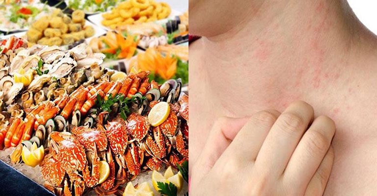 Nổi mề đay do dị ứng thức ăn cần tránh cho con bú