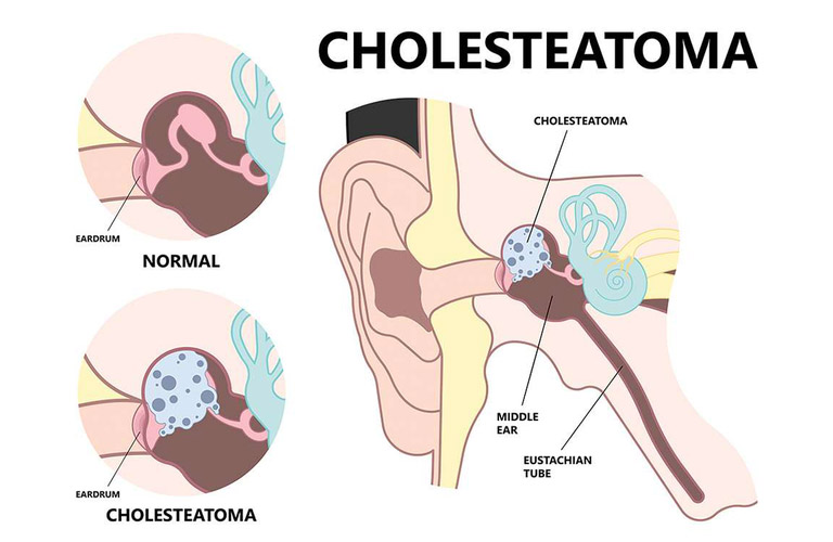 Cholesteatoma là một khối u lành tính phát triển trong tai giữa