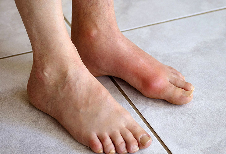 Gout có thể là nguyên nhân gây đau nhức xương khớp ở người trẻ