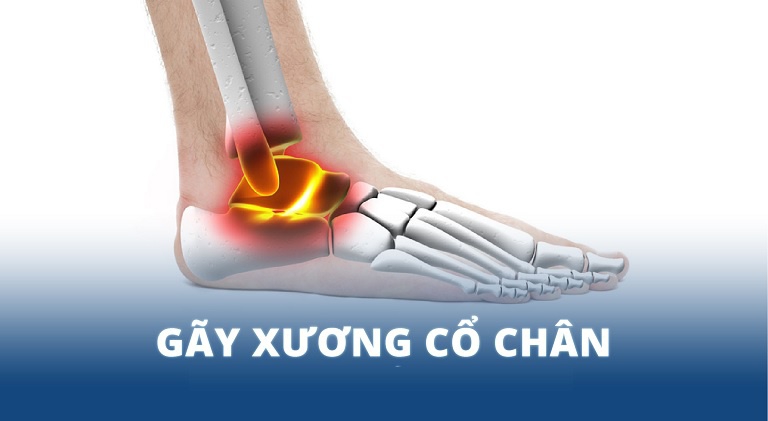 Hình ảnh xương cổ chân bị gãy