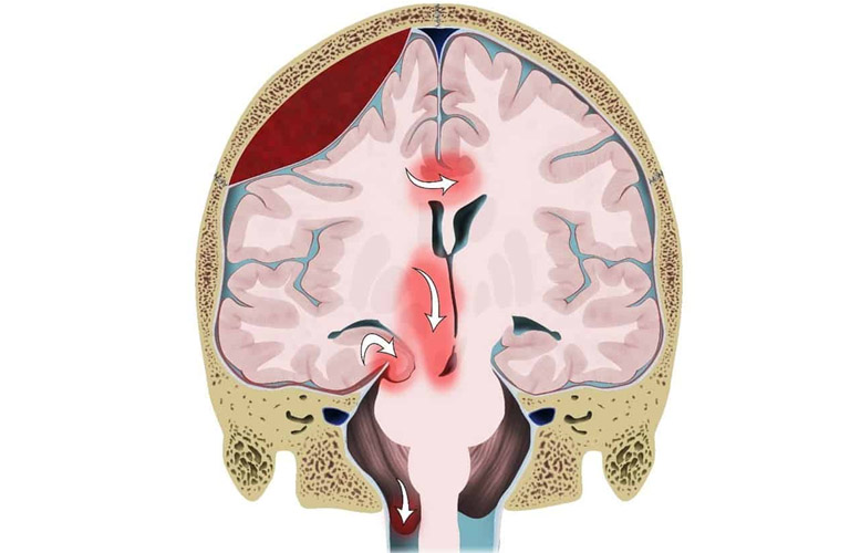 Thoát vị não là một biến chứng của rối loạn gây tăng áp lực nội sọ