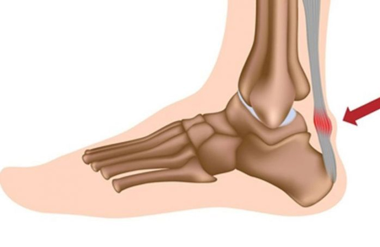 Viêm gân ở cổ chân thường do sử dụng quá mức hoặc do chấn thương