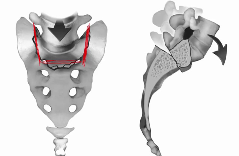 Gãy xương cùng (Sacral Fracture)