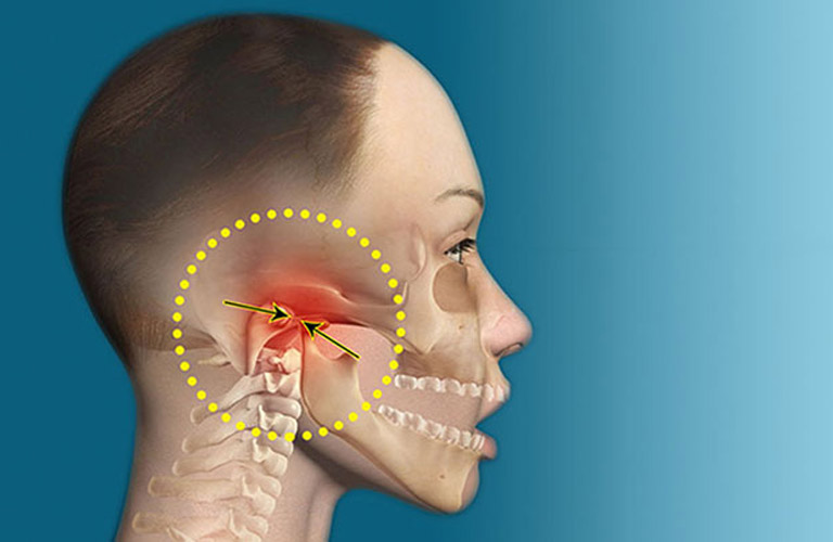 Rối loạn khớp thái dương hàm (temporomandibular joint disorder - TMD)