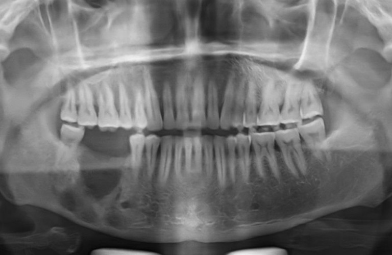 Viêm xương tủy (Osteomyelitis)