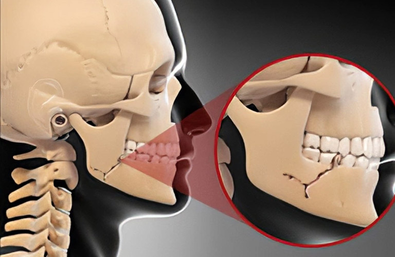 Gãy xương hàm (Jaw Fracture)