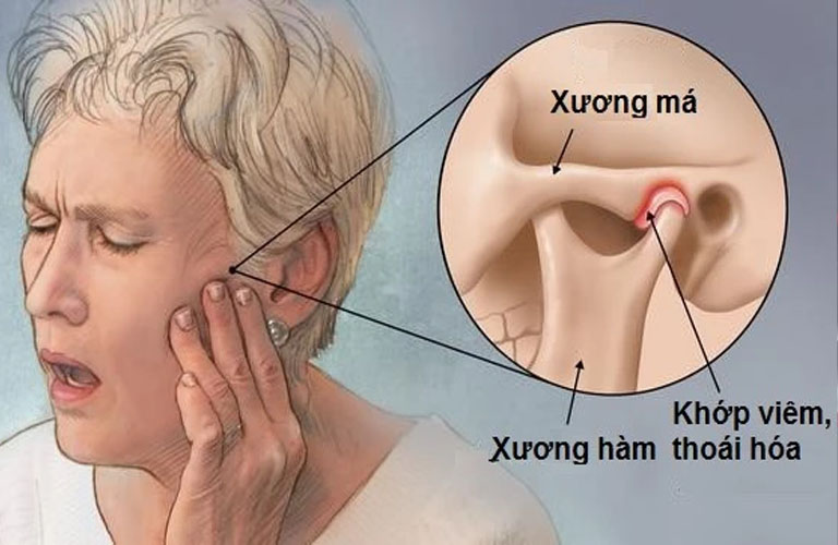 Viêm khớp thái dương hàm (temporomandibular joint arthritis)