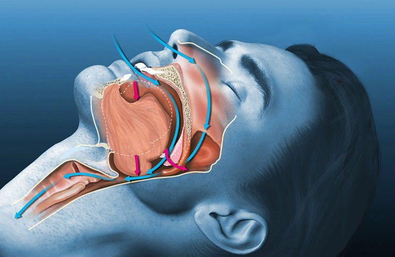 Hội chứng hô hấp ngưng thở khi ngủ (Obstructive Sleep Apnea)