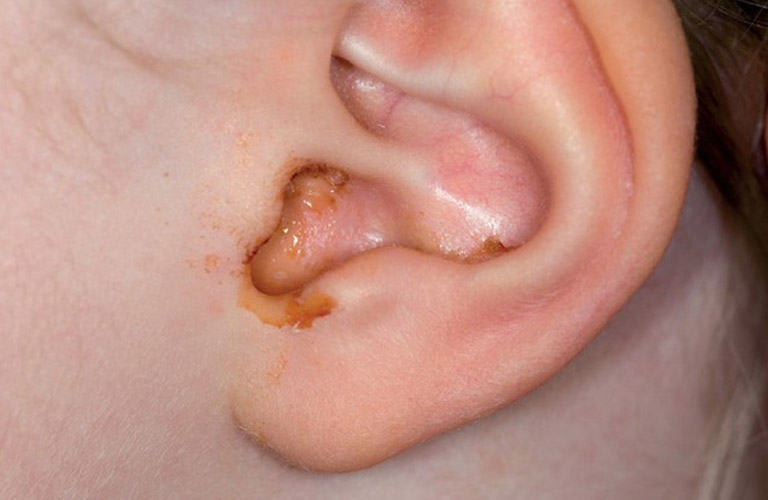 Viêm tai giữa cấp tính và mãn tính (Otitis Media)