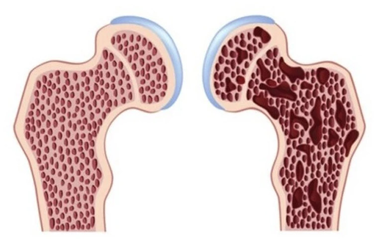 Bệnh xương thủy tinh hay còn gọi là bệnh xương dễ gãy