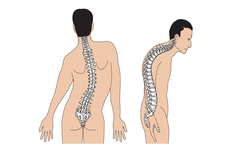 Người bệnh dễ bị biến dạng cột sống